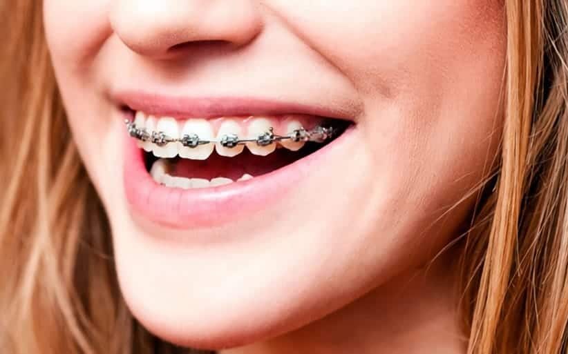brackets