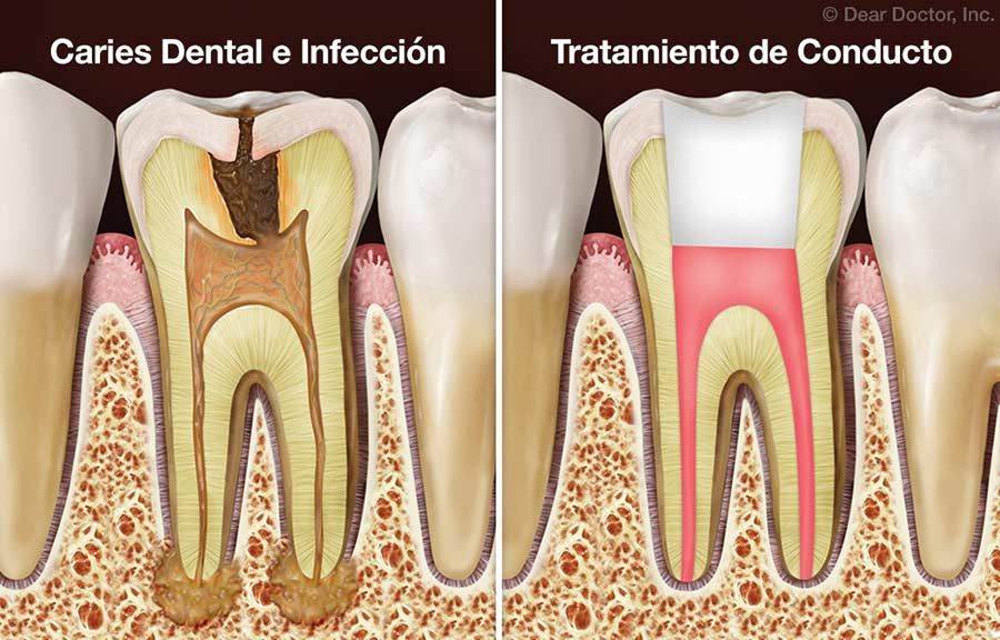 Endodoncia